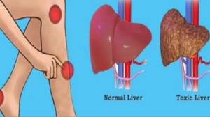 Semne de avertizare că ficatul este supraîncărcat cu toxine si pe care nu trebuie să le ignori