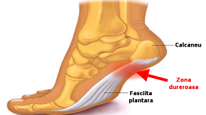 Scapă de pintenii calcaneeni (ciocuri la călcâie) cu un amestec simplu preparat în casă!