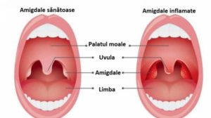 Ce este amigdalita cronica si cum se trateaza